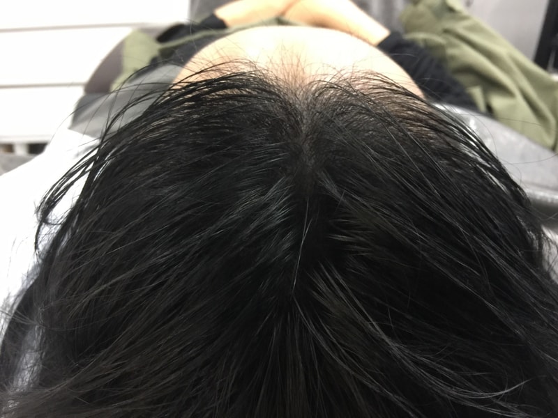 전두부 후.jpg