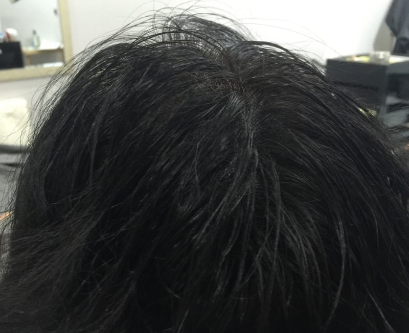 정수리 후.jpg