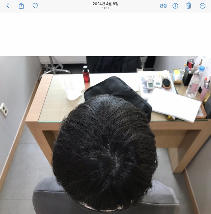 시술 후 4년.jpg