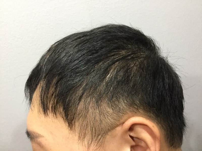 미켈란 두피문신 전.jpeg