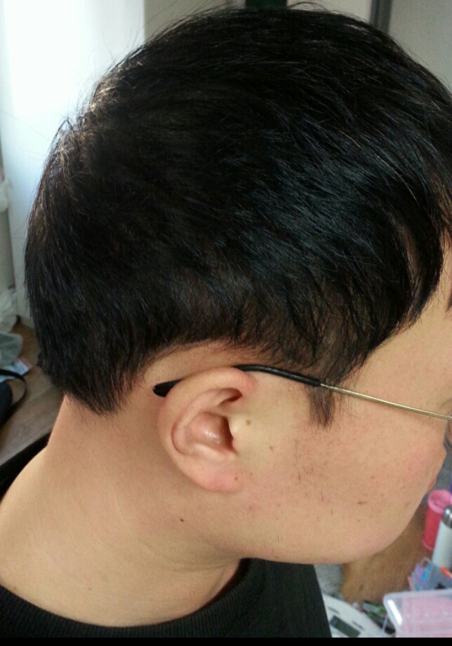 미켈란 두피문신 후.png