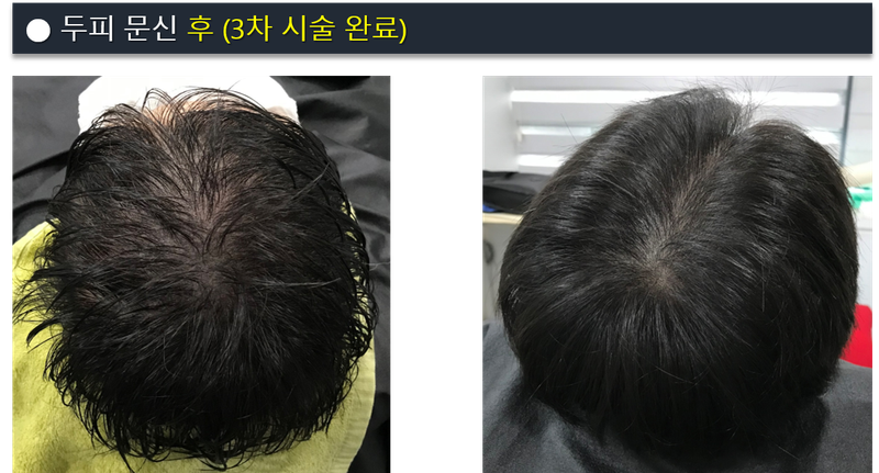 두피문신 후.png