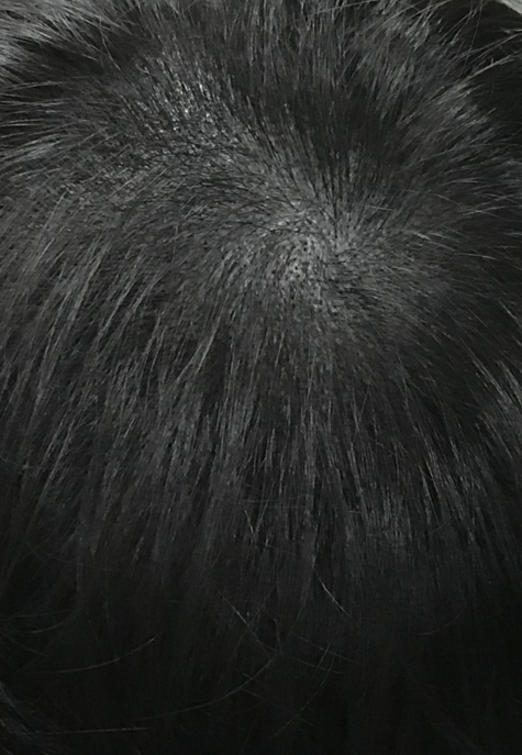 두피문신후.png