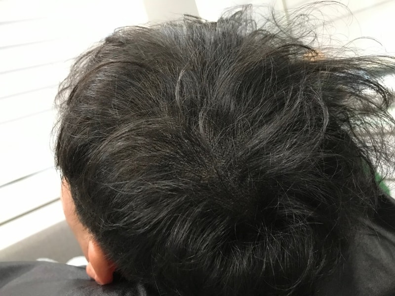 시술 후 드라이7.jpg