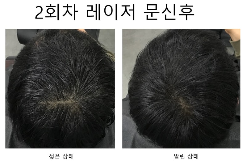 2회차 레이저 문신후.jpg