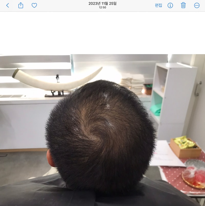 연세미다인 정수리+전두부 두피문신 3년 찐후기!!