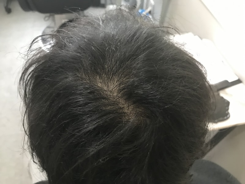 물에 안 젖었을때 시술 전.jpg