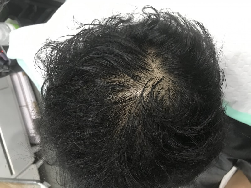 물에 젖었을때 시술전.jpg
