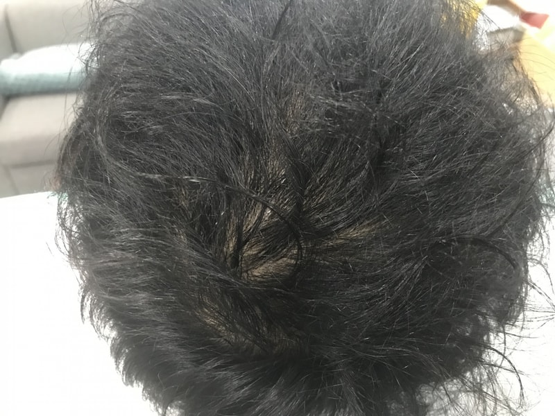 물에 안 젖었을때 시술전2.jpg