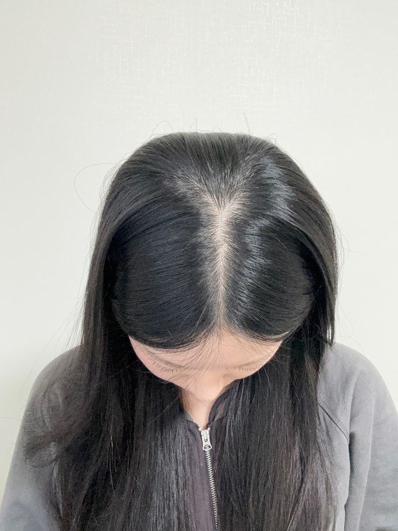 가르마 두피문신 4회차 모원성형외과 정재홍원장님