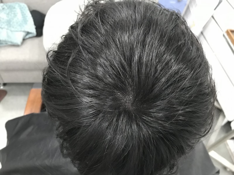 시술 후 말랐을 때.jpg