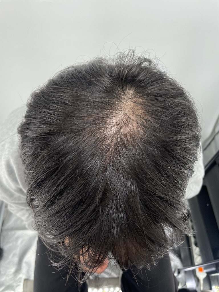 두피문신을 알아보다 우연히 강남 뉴헤어성형외과를 알게되었습니다. 유튜브로 찾게된 곳이 이 탈모전문병원!