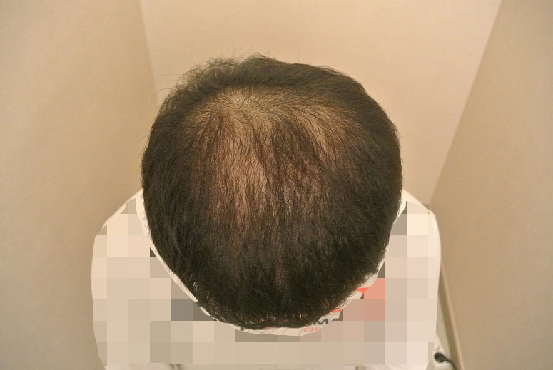 두피문신2.jpg