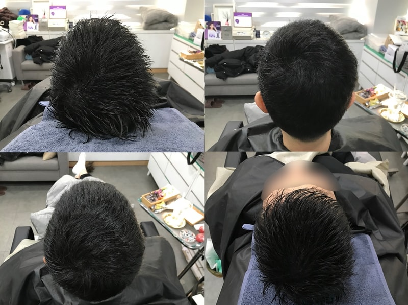 시술후.jpg