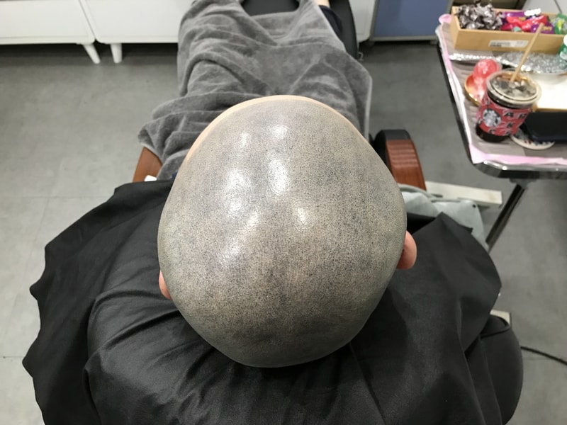 시술후2.jpg