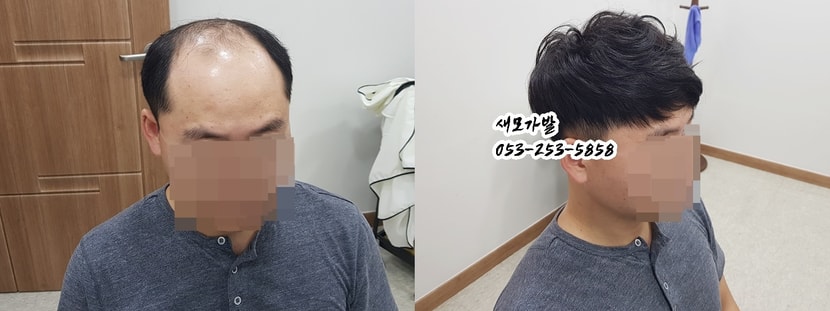 대구새모가발