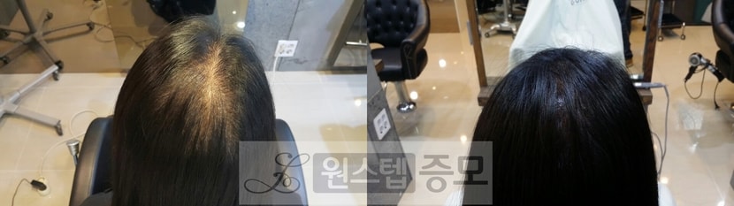 여자정수리탈모