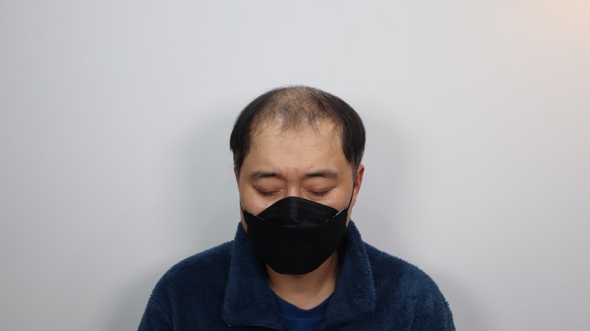 시술 전_정면
