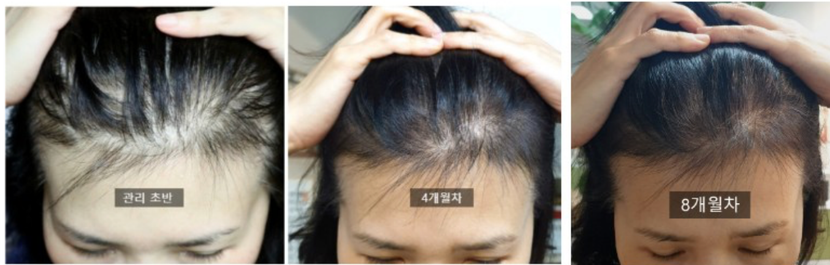 사용전 -&gt; 후 