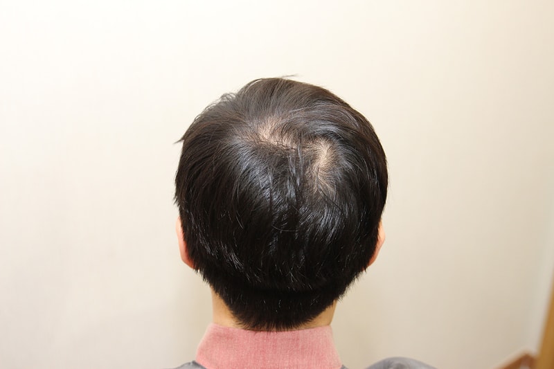 두피문신 전.jpg
