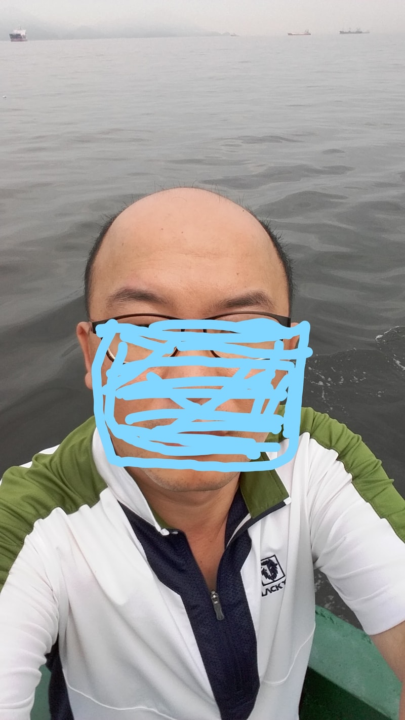 모발이식전사진.jpg
