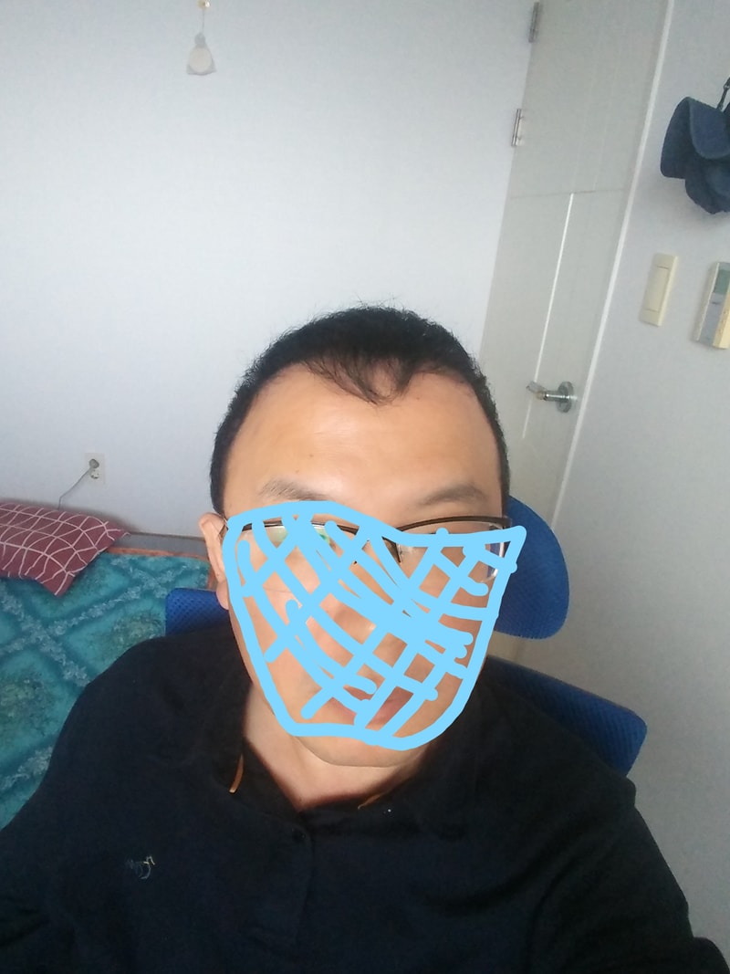 모발이식후.jpg