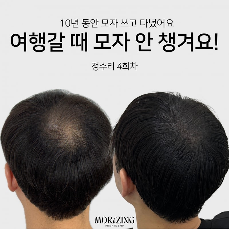 Beige and Blue Minimalist Beauty Skincare Before After Collage Instagram Post의 사본.png
