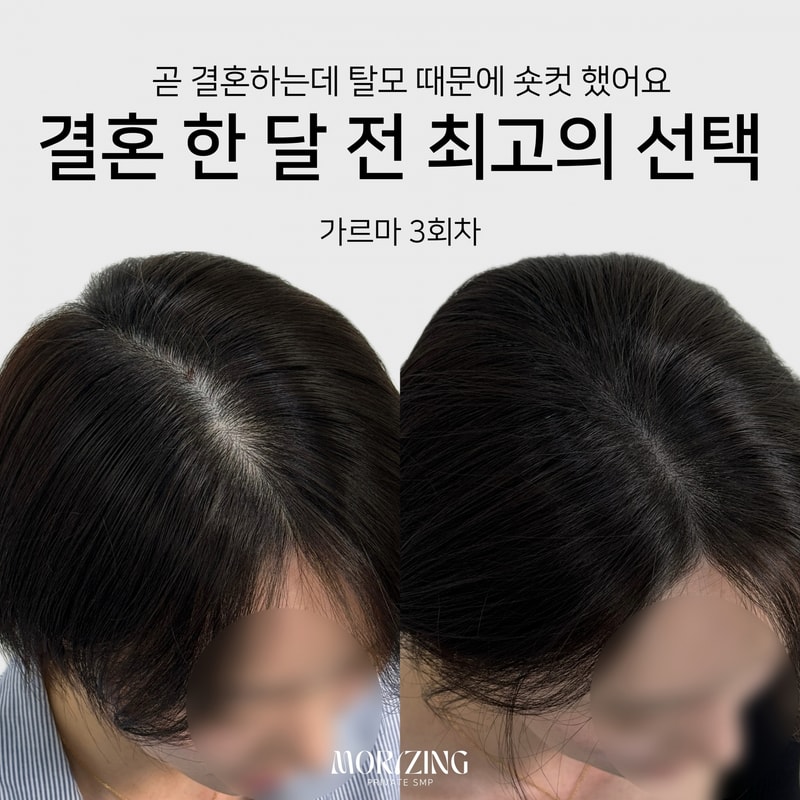 Beige and Blue Minimalist Beauty Skincare Before After Collage Instagram Post의 사본.png