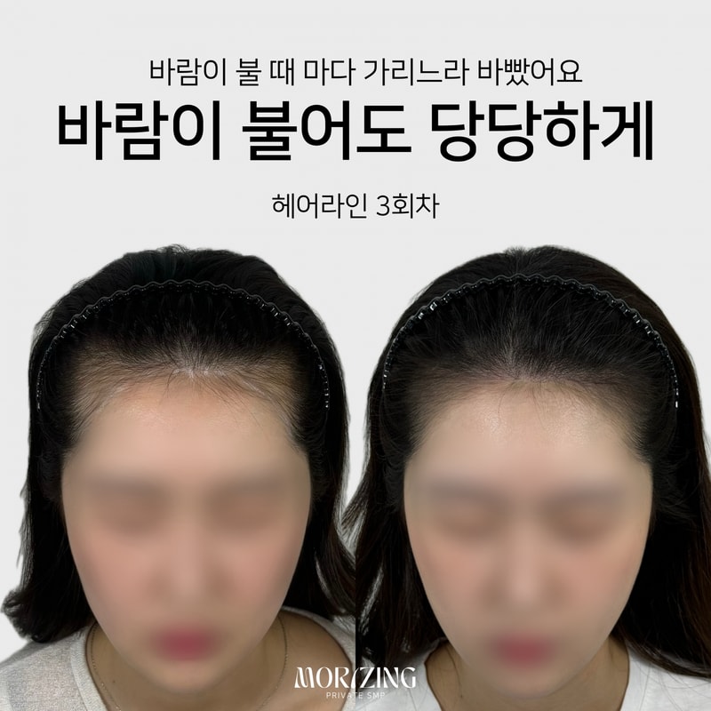 Beige and Blue Minimalist Beauty Skincare Before After Collage Instagram Post의 사본.png