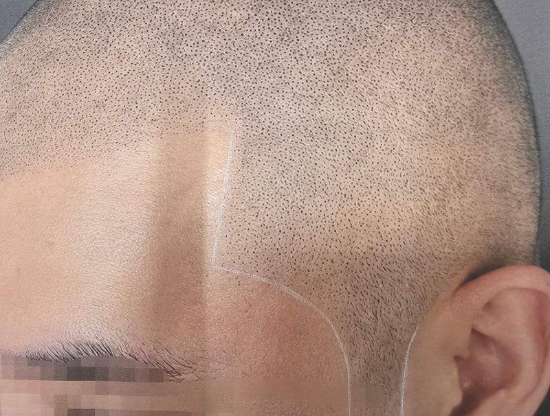 남성 숱채움 측두부 모델 구합니다! 명동역5분거리 