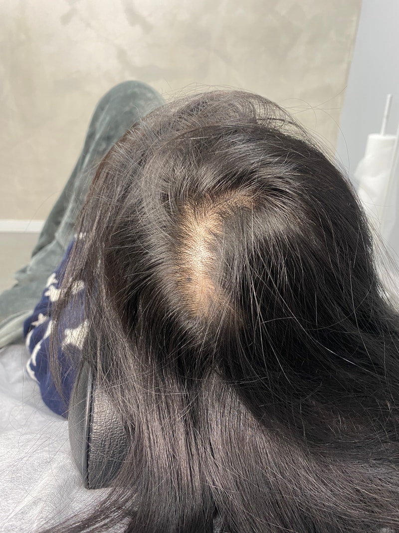 흑채, 부분가발이랑 작별한 썰 푼다...(SMP 솔직 후기)