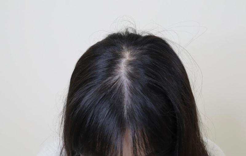 정수리 노출 고민, SMP로 해결한 후기
