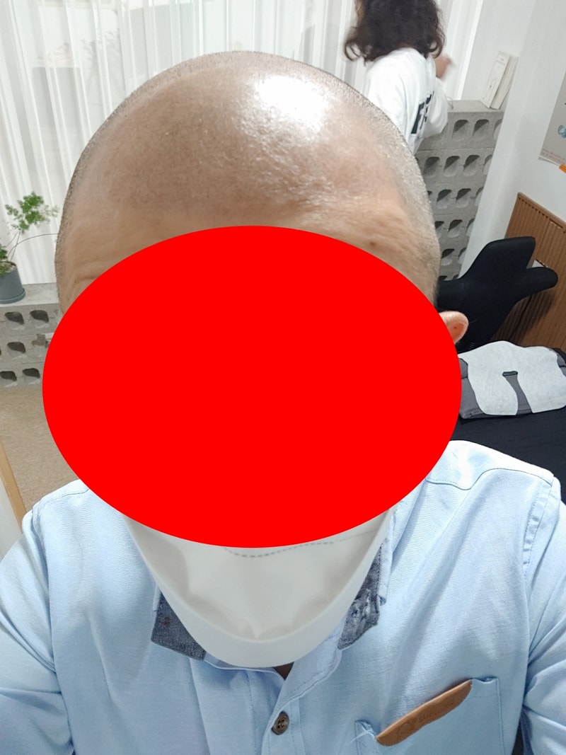 두피문신1.jpg