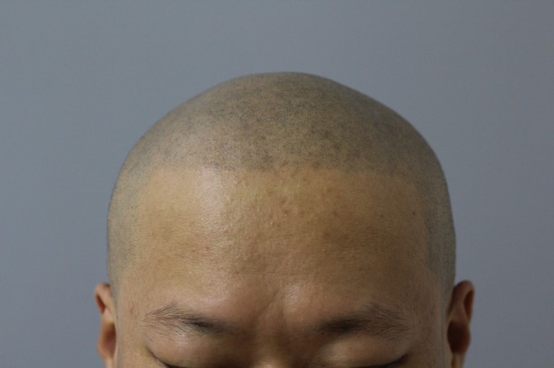 시술후_IMG_1.JPG