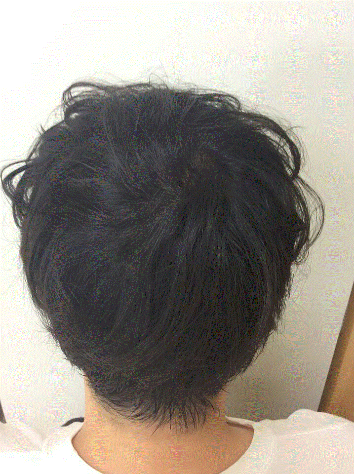 시술직후.gif