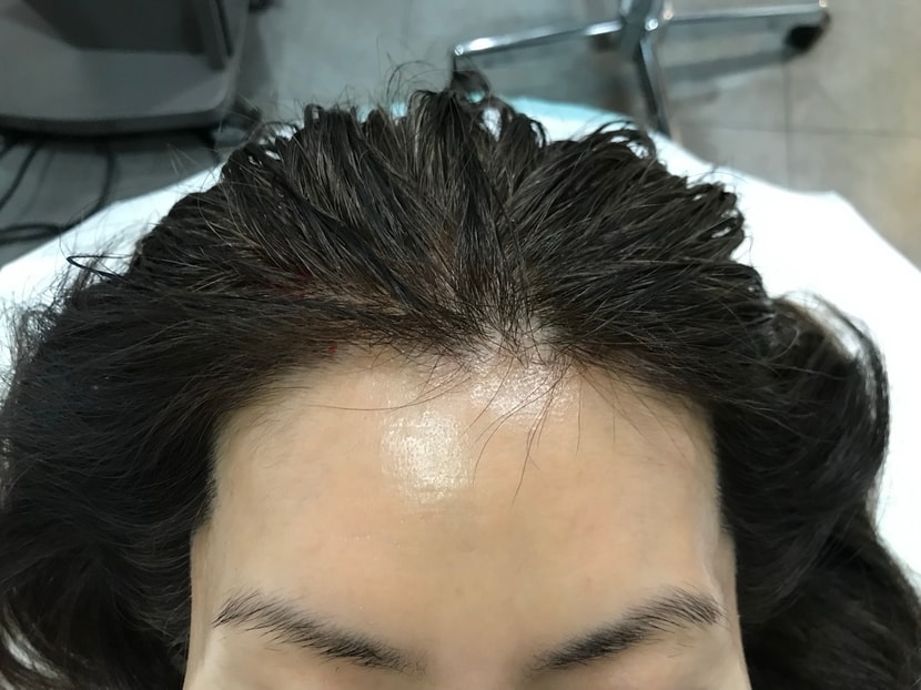 두피문신 전