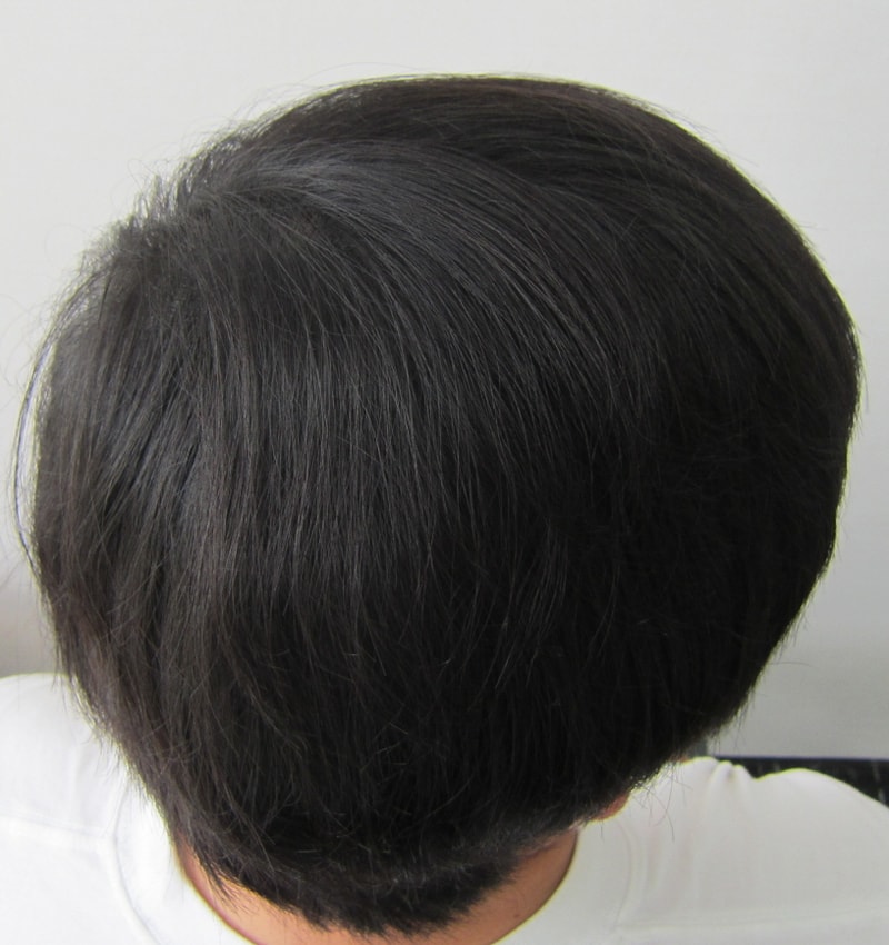 시술후3.JPG