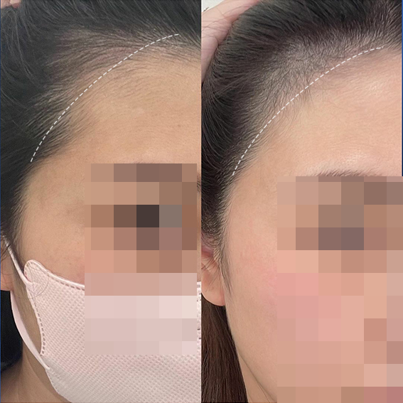 ㅊㄹ 헤어라인.jpg