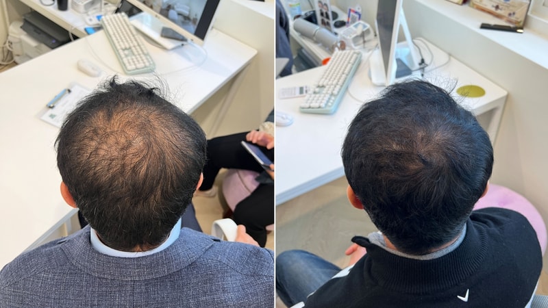 ㅅㅇㅅ 비포에프터5차.jpg