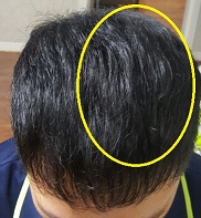 동그라미 (머리흉터).jpg
