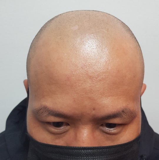 시술전