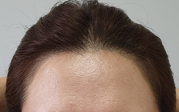 두피문신한거후.png