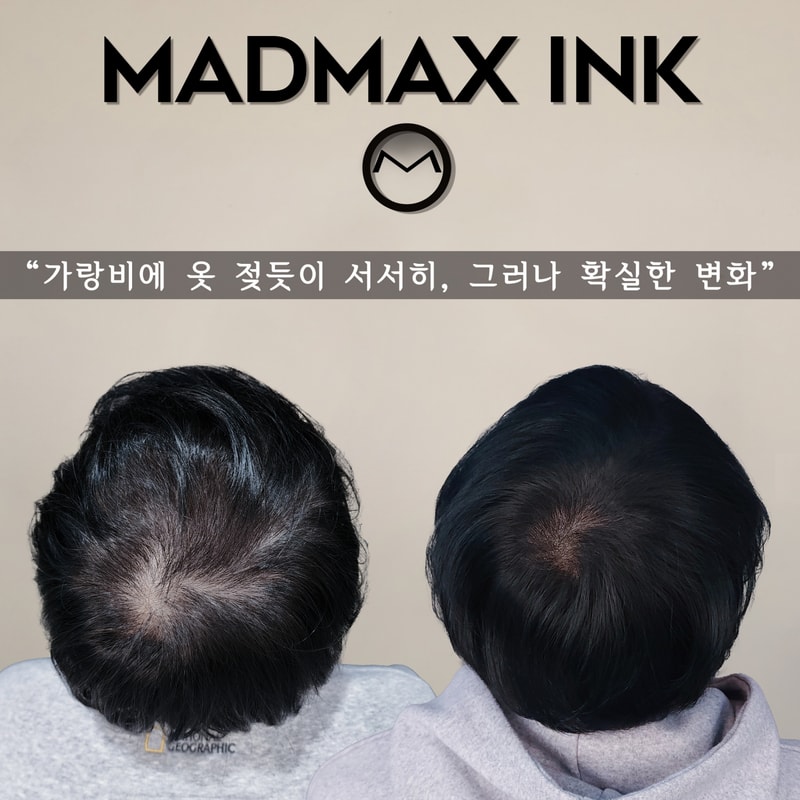 두피 정수리 숱채움-1.jpg