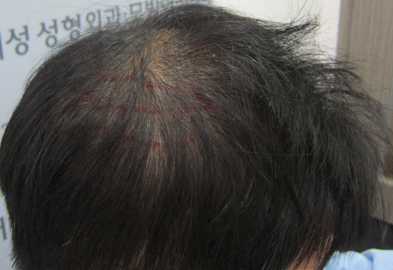 두피문신 시술전 3.JPG