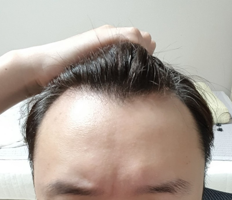 M자탈모.jpg