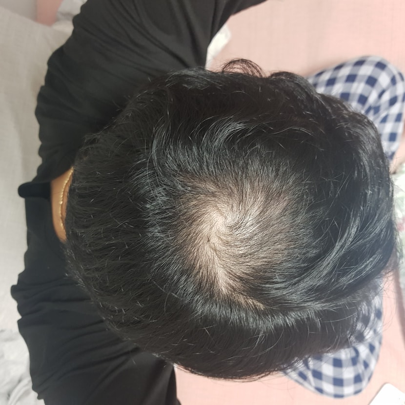 2022년 가장 정수리탈모가 심할때 사진