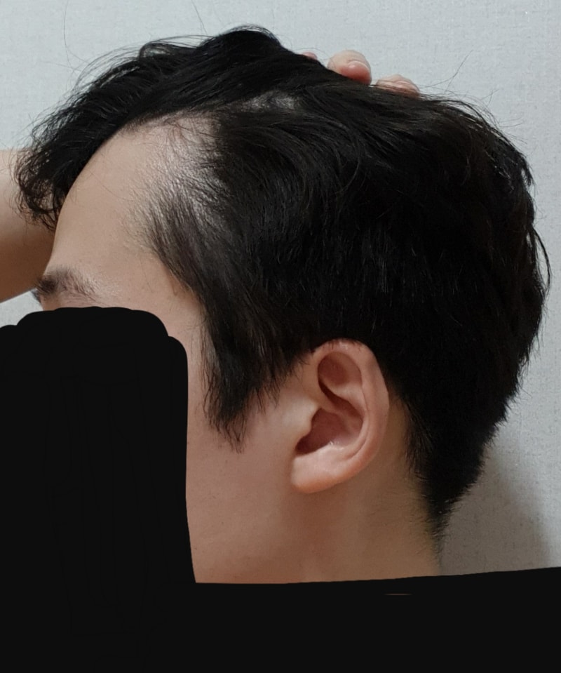 탈모3.jpg