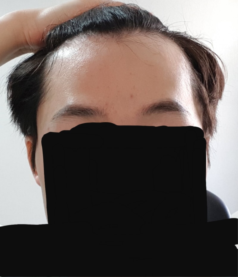 탈모.jpg