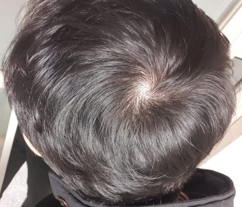 복용 2개월차 많이 회복되었습니다