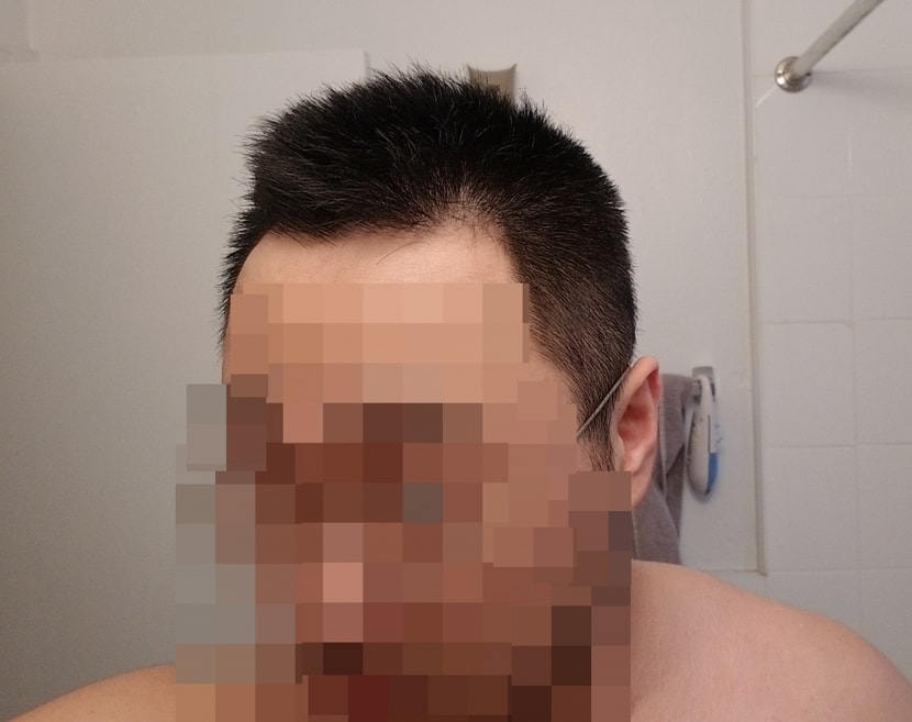 평상시 머리 좌측. 이 사진 보면 뭔가 딱 비어보이지 않나요?